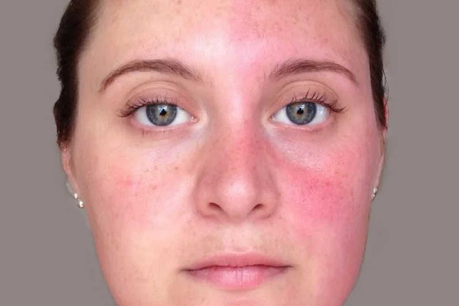 Síndrome de Arlecchino