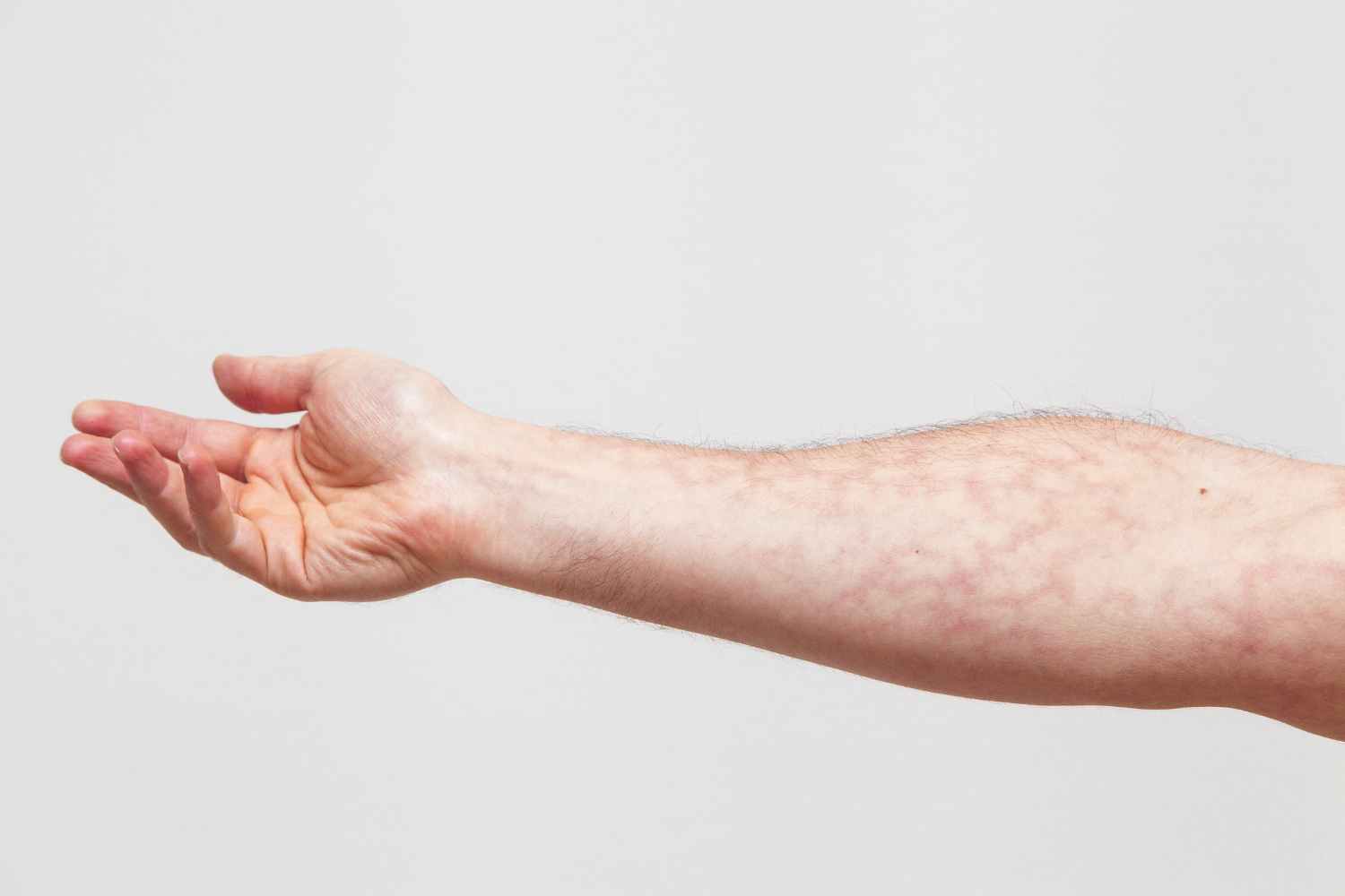 acupresión del antebrazo