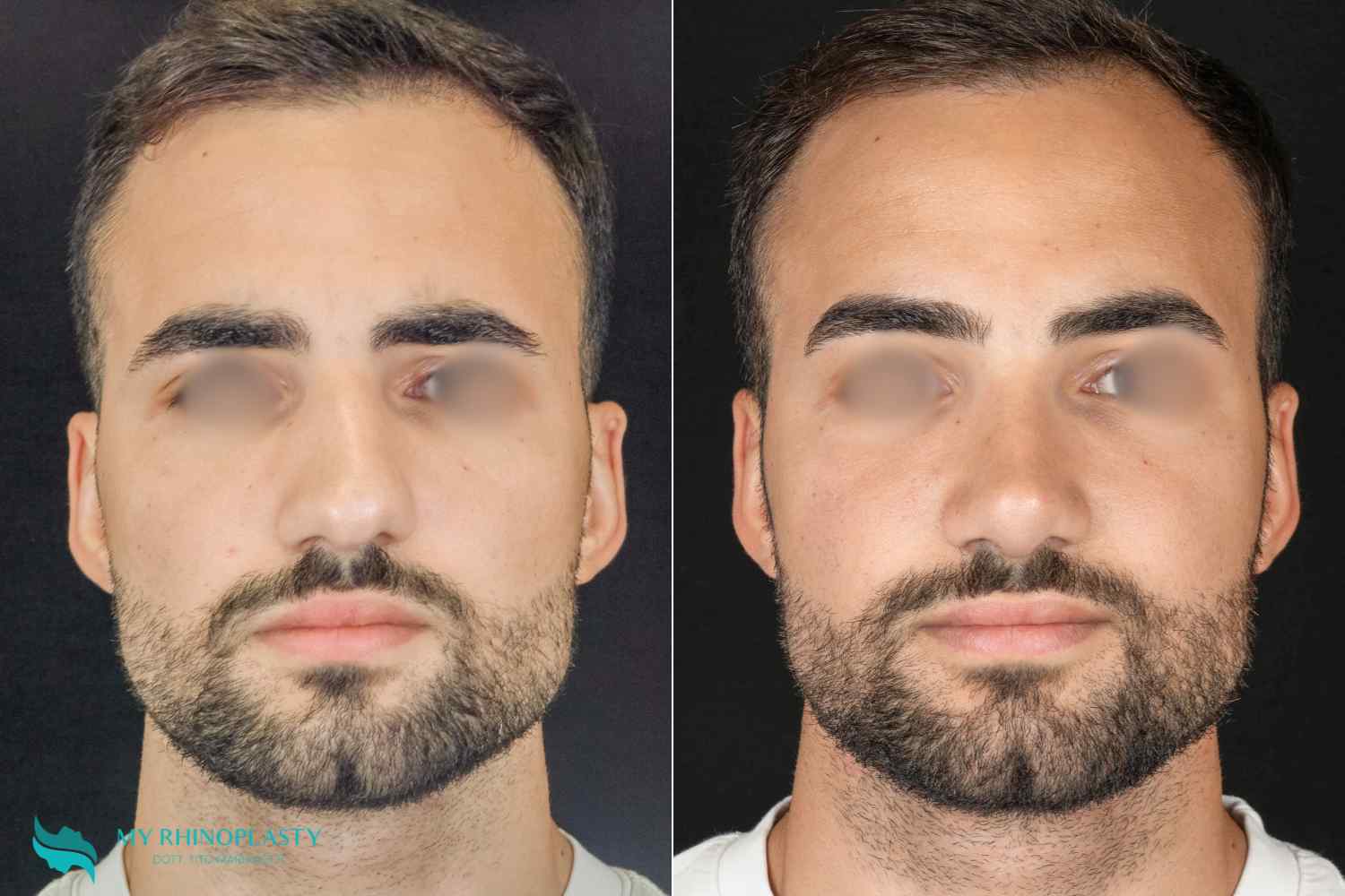 tabique nasal desviado 