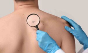 Melanoma, el error que cometemos todos bajo el sol (y no es olvidarnos de la crema)