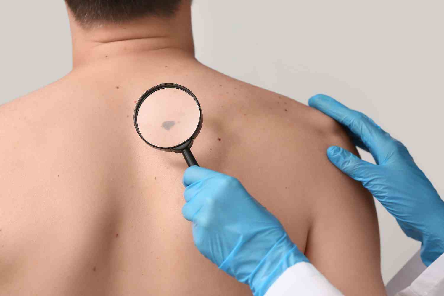 melanoma