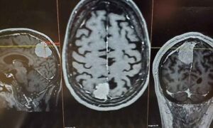 Cáncer de cerebro: se descubre una nueva estrategia para bloquear las células tumorales “in situ”
