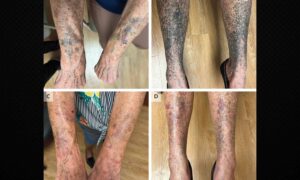 Toma antibiótico para la rosácea y le salen manchas azules: el “extraño” caso de hiperpigmentación que ha asombrado hasta a los científicos