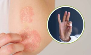 Psoriasis, la nueva pastilla dirigida supera el primer examen europeo y allana el camino para un tratamiento revolucionario sin inyecciones