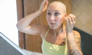 Alopecia: este fármaco común para la artritis está provocando que a 1.400 pacientes les vuelva a crecer gran parte del cabello