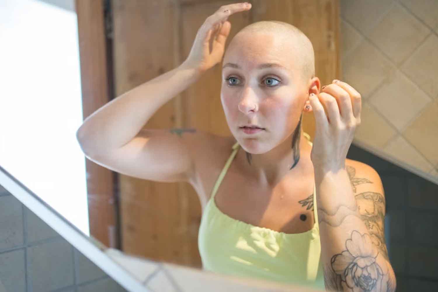 alopecia