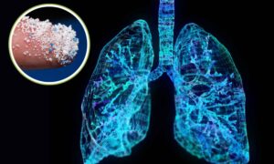 Microplásticos: se encuentran cada vez más (y con mayor frecuencia) en pacientes con cáncer de pulmón