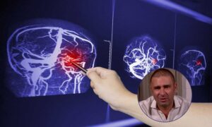 Edema cerebral provocado por un tumor: qué es, cuáles son los síntomas y cómo se trata