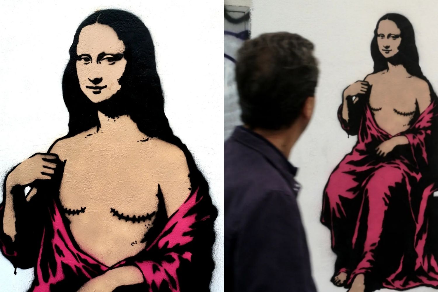 mona lisa mastectomia
