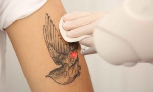 Quitar un tatuaje no es tan sencillo: costes, tiempos y riesgos que hay que saber según los expertos